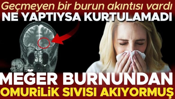 Geçmeyen bir burun akıntısı vardı, ne yaptıysa kurtulamadı! Meğer burnundan omurilik sıvısı akıyormuş