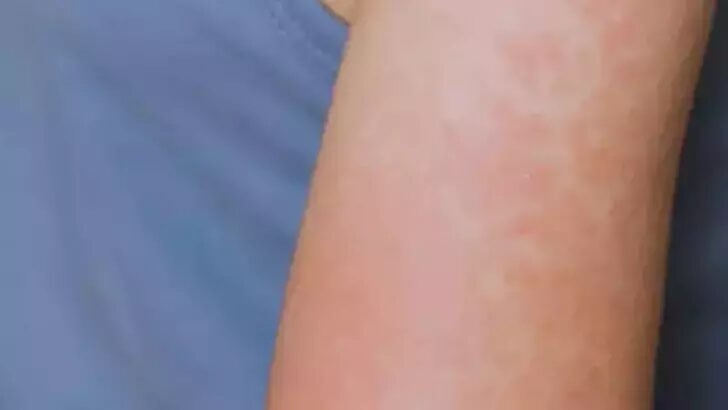 ABD, – ABD’de enfeksiyon vakalarının artmasıyla Kansas eyaletinde 23 kızamık