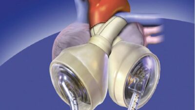 AVUSTRALYA, – AVUSTRALYA’da bir hasta yapay kalp nakli ile 100