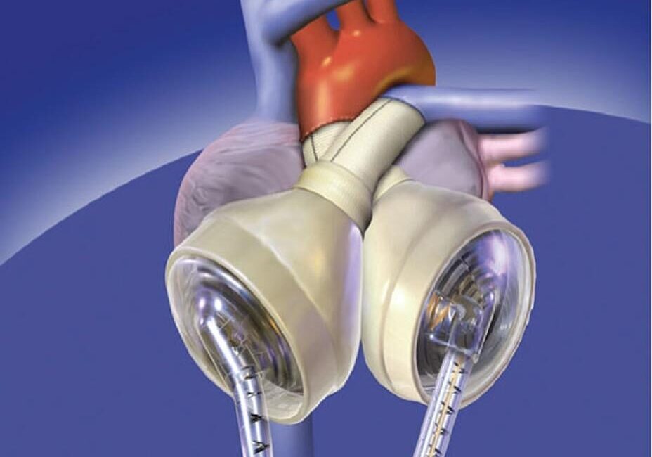 AVUSTRALYA, – AVUSTRALYA’da bir hasta yapay kalp nakli ile 100